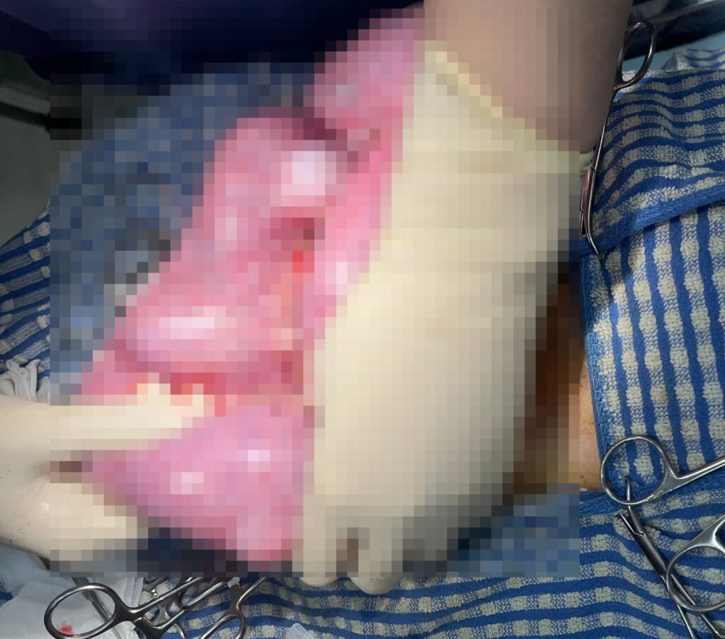강아지 자궁축농증으로 확장된 자궁