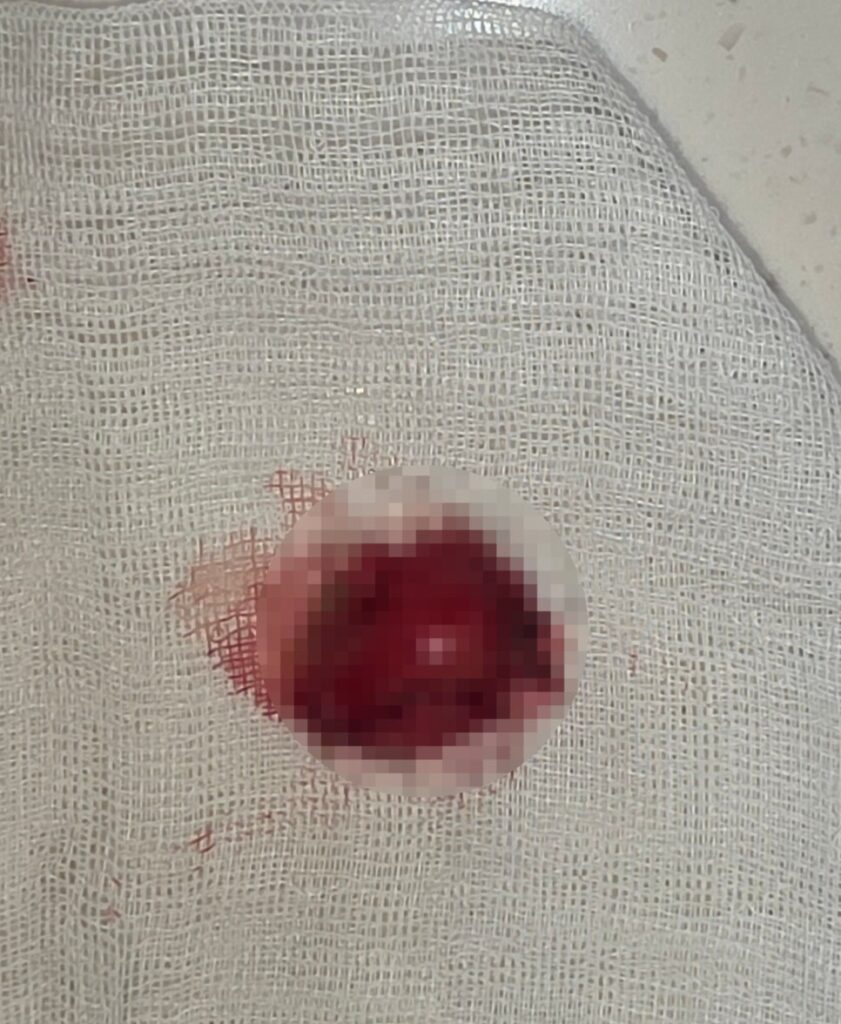 강아지 침샘낭종 제거조직